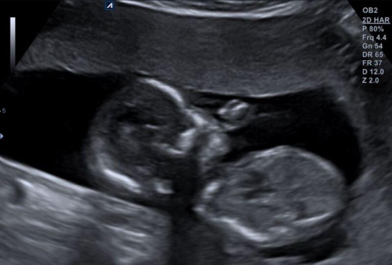 Echo foto - gender reveal